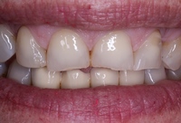 Επιμήκυνση προσθίων δοντιών με σύνθετη ρητίνη